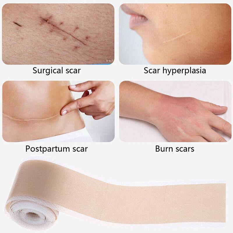 Silicone Gel Tape Scar Removal Self-Adhesive Efficient Scar Removal Patch Tapes - 4*150CM